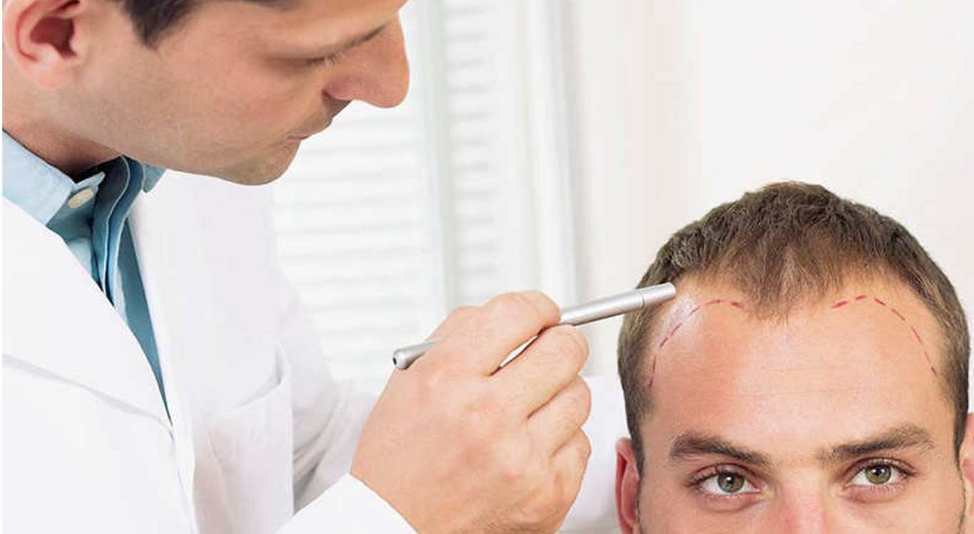 A-detailed-comparison-of-hair-transplantation-and-hair-prosthesis