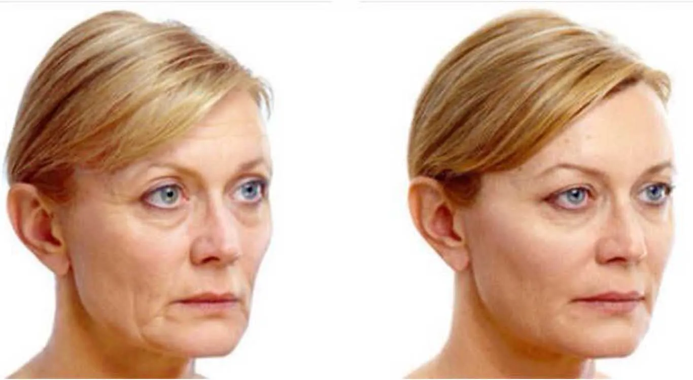 Add-permanent-fullness-to-your-face