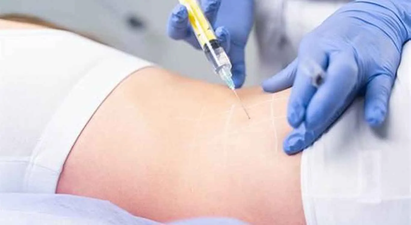 Body-filler Body-filler