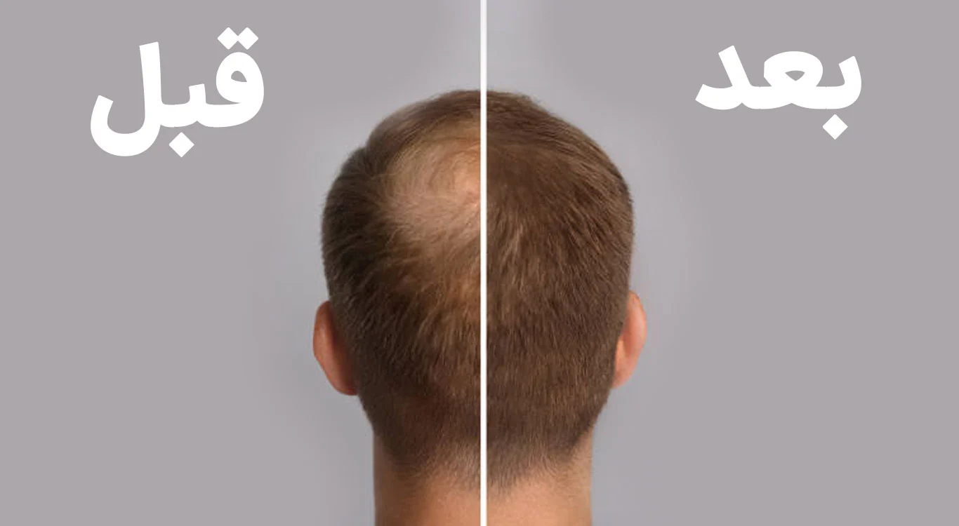 Effective-hair-mesotherapy-treatment Effective-hair-mesotherapy-treatment