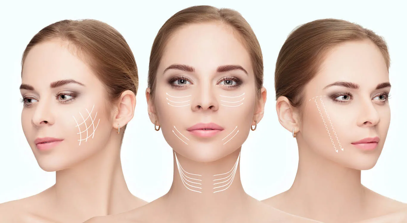 Facial-transformation-with-a-thread-facelift