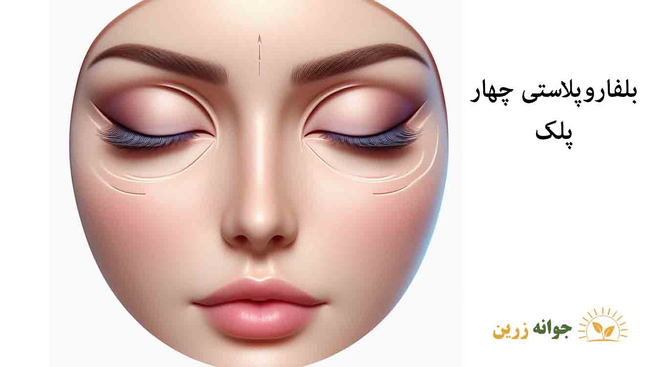 Four-eyelid-blepharoplasty