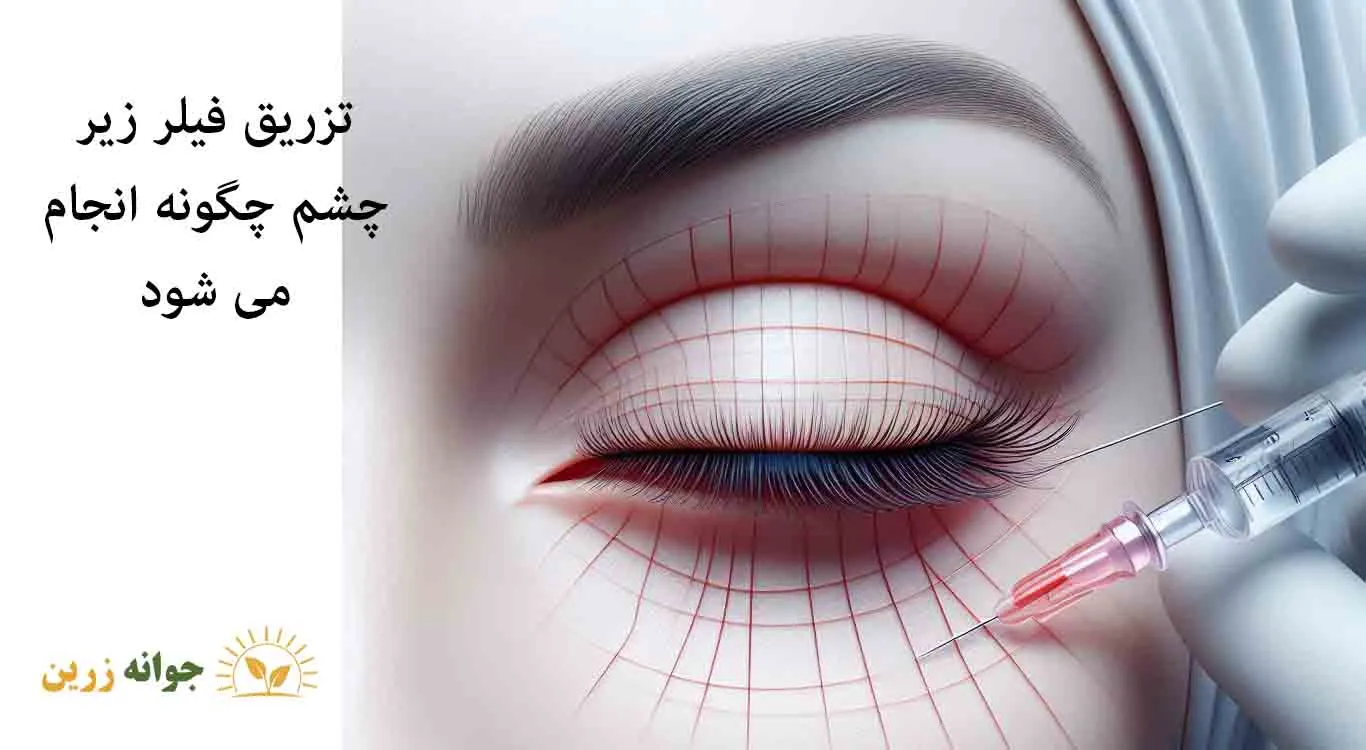 How-to-inject-filler-under-the-eyes