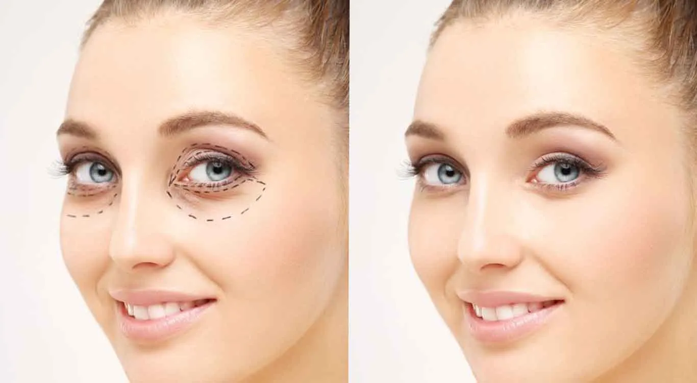 Learn-Blepharoplasty-Professionally-From-zero-to-entering-the-labor-market