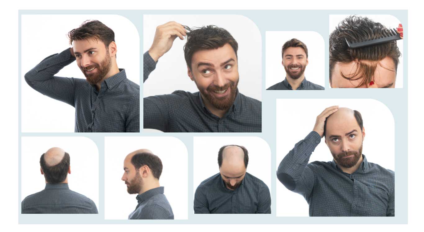 Modern-hair-transplantation-2025