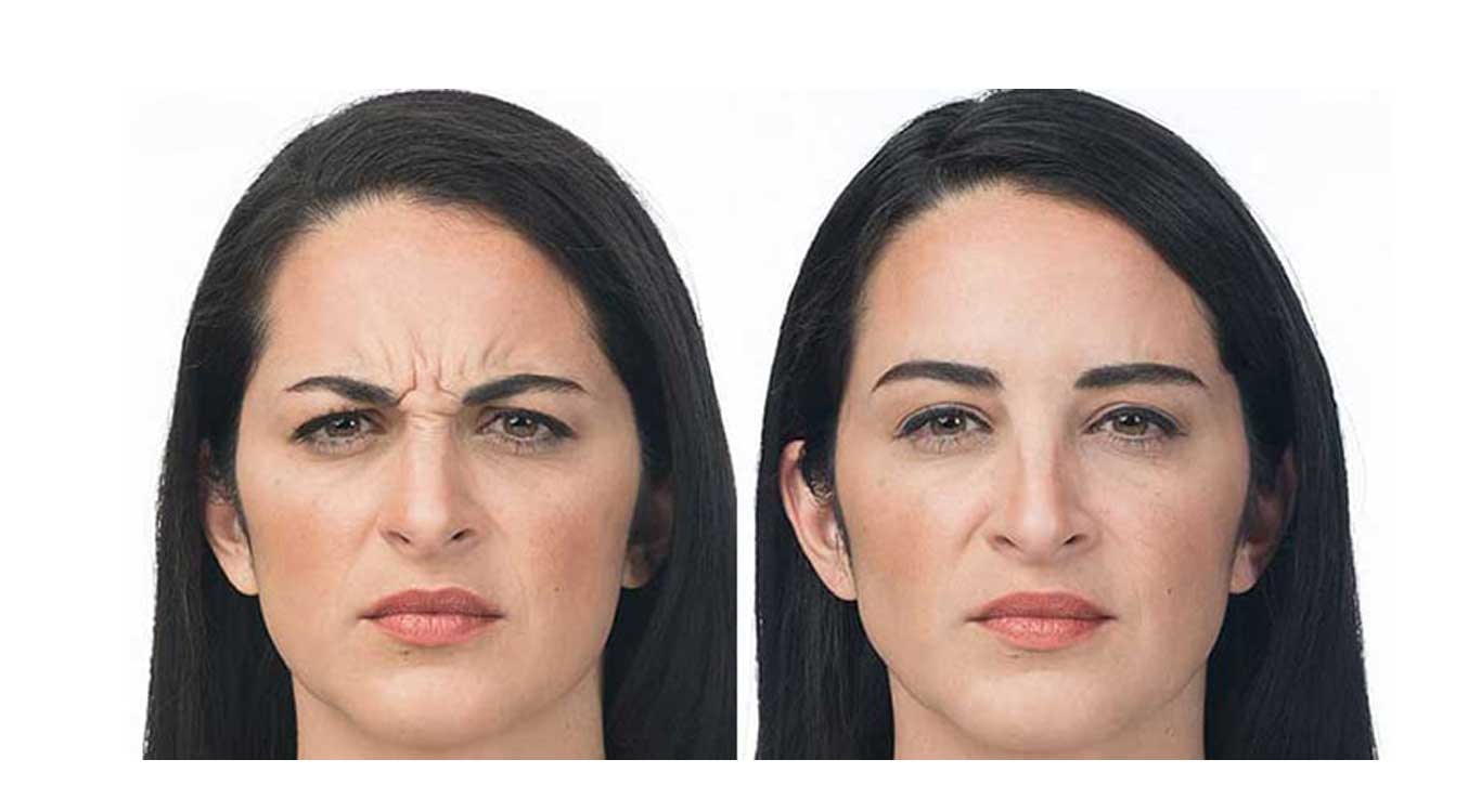 Removing-frown-lines-with-Botox-or-fillers