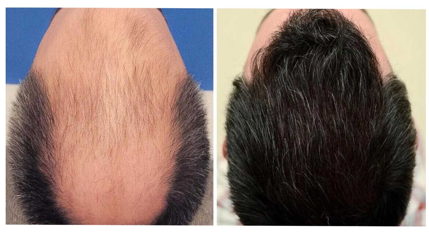 Specialized-hair-transplantation-training-with-state-of-the-art-methods