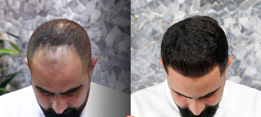 What-is-hair-banking-and-hair-grafting