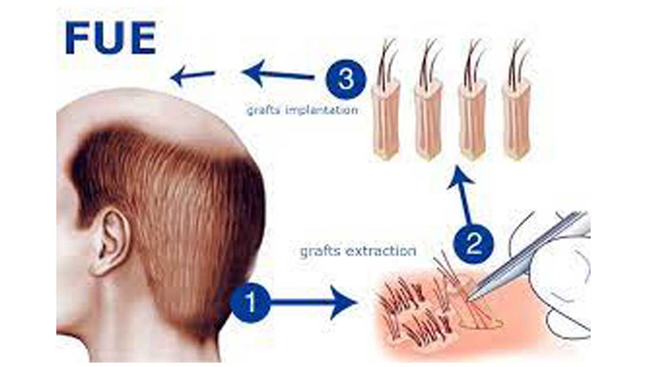 Where-do-they-get-hair-for-hair-and-eyebrow-transplants