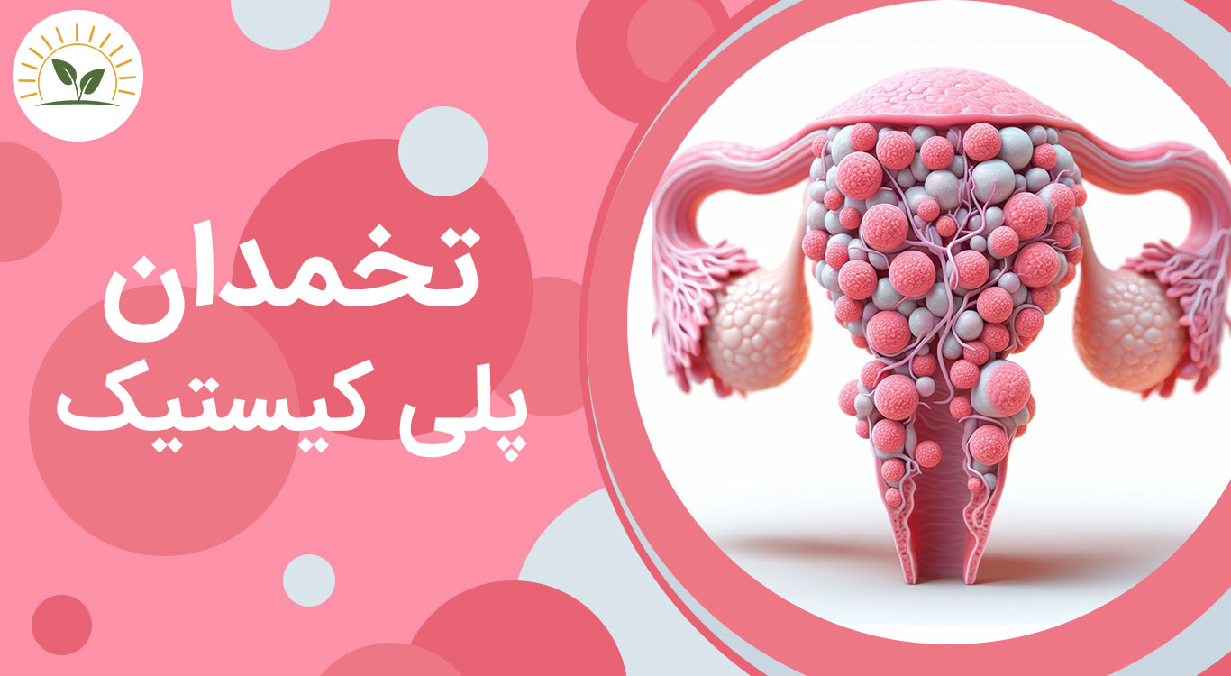 polycystic-ovary-syndrome-(pcos)